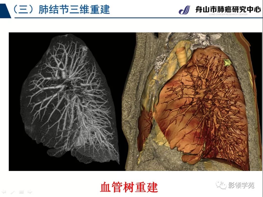 影像PPT - 【PPT】肺良恶性结节CT征象及鉴别诊断-22