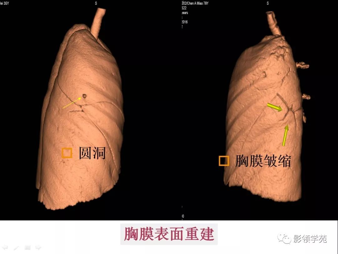 影像PPT - 【PPT】肺良恶性结节CT征象及鉴别诊断-21