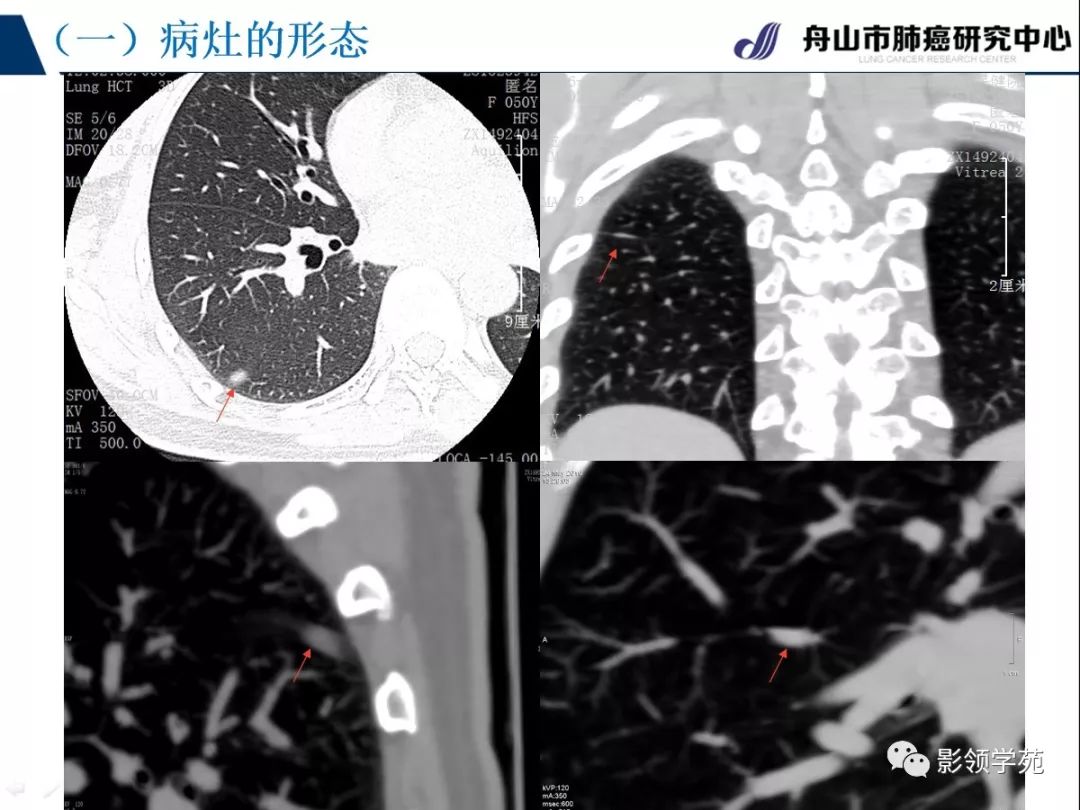 影像PPT - 【PPT】肺良恶性结节CT征象及鉴别诊断-25