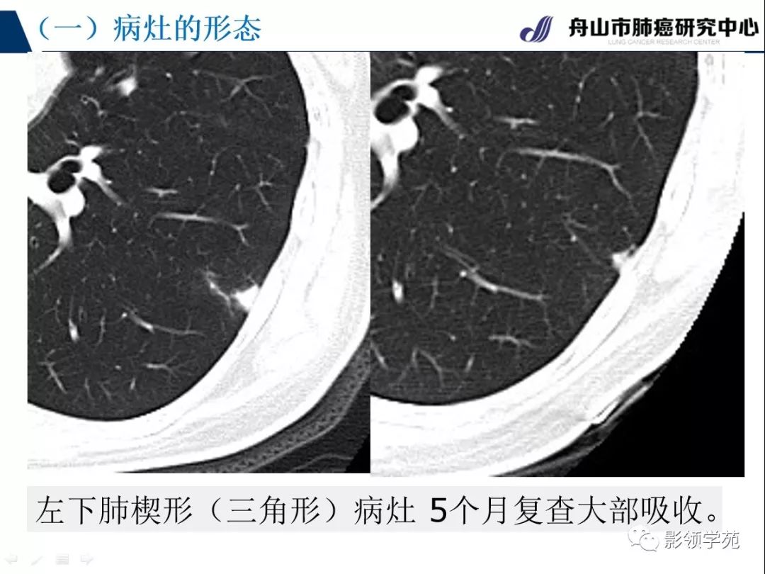 影像PPT - 【PPT】肺良恶性结节CT征象及鉴别诊断-26