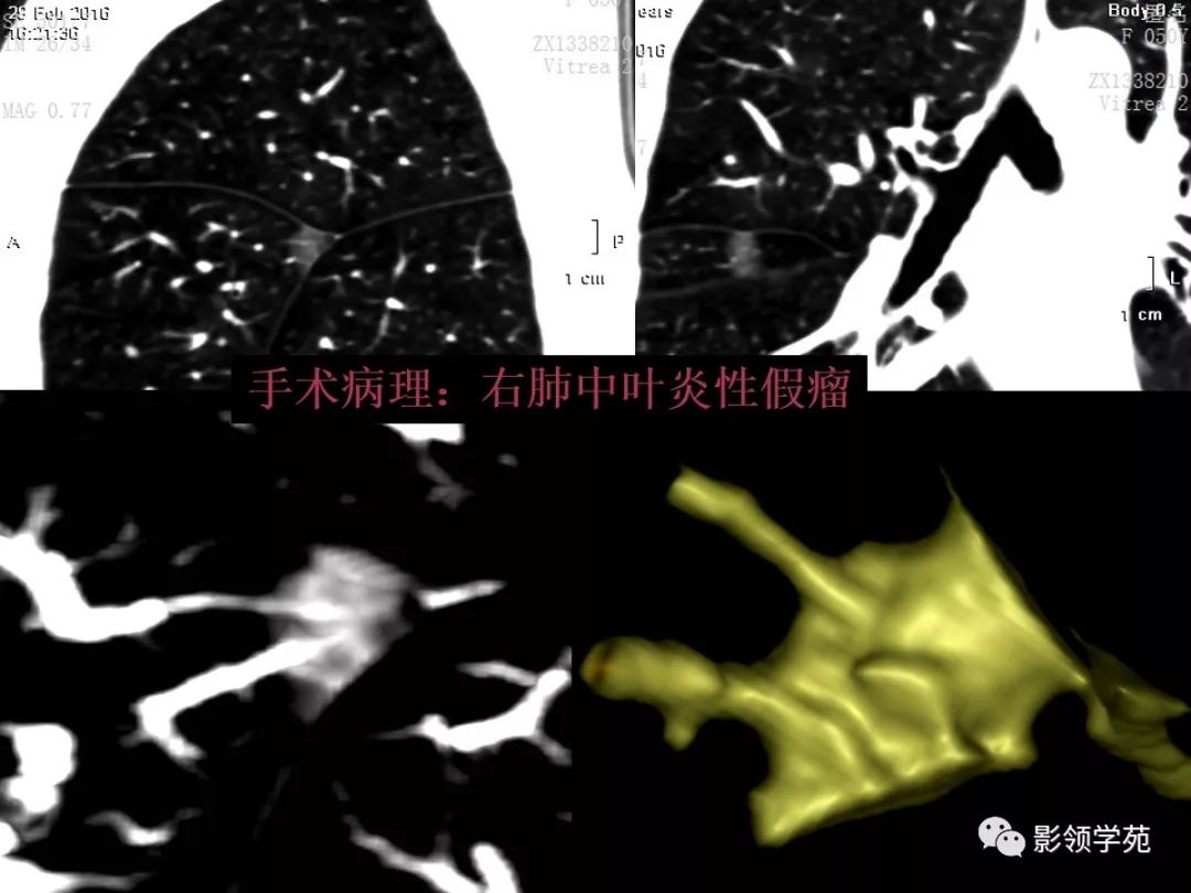 影像PPT - 【PPT】肺良恶性结节CT征象及鉴别诊断-30
