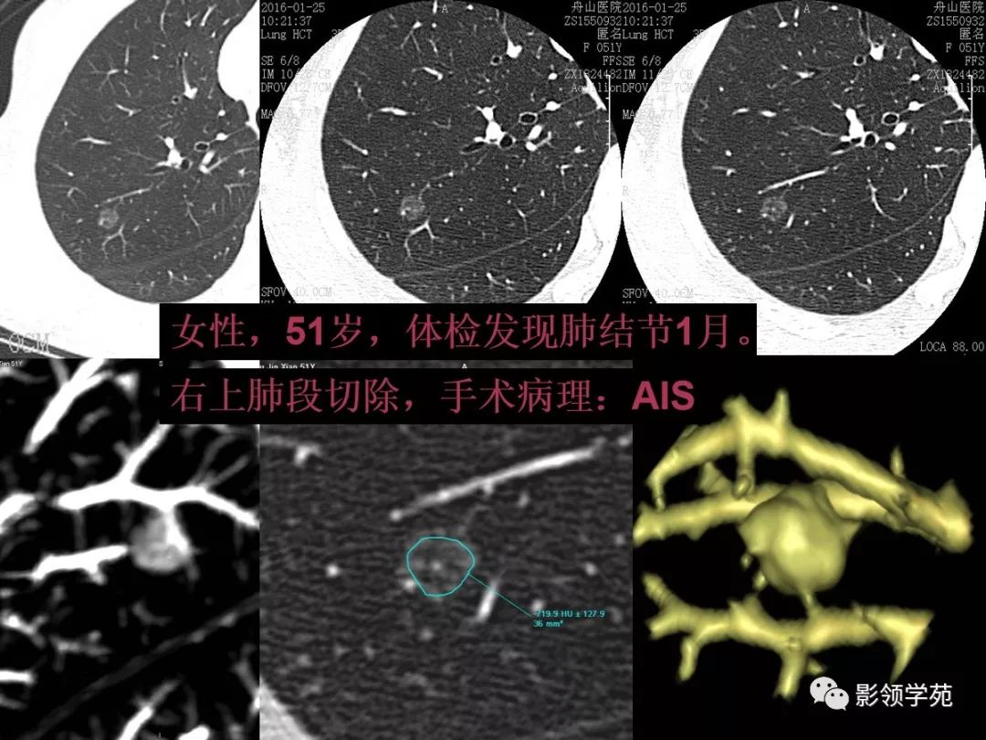 影像PPT - 【PPT】肺良恶性结节CT征象及鉴别诊断-28