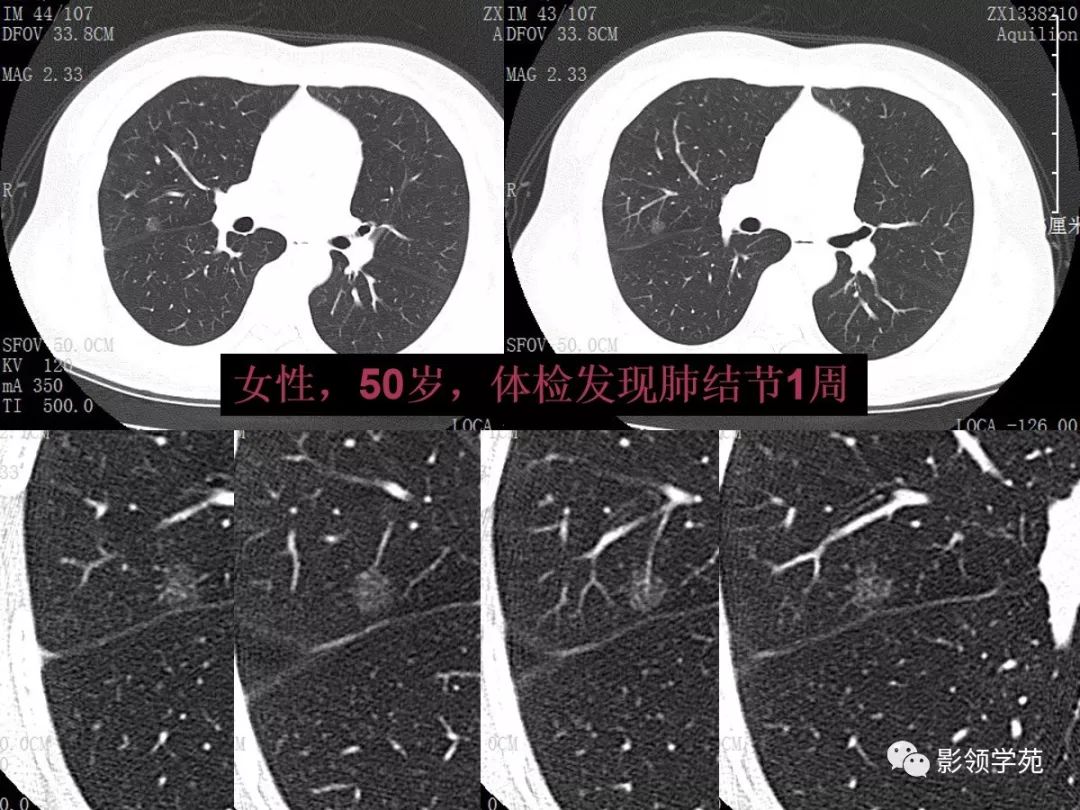 影像PPT - 【PPT】肺良恶性结节CT征象及鉴别诊断-29