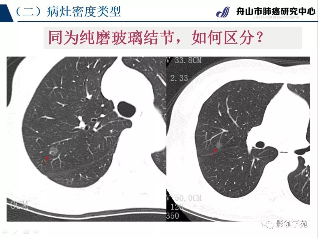 影像PPT - 【PPT】肺良恶性结节CT征象及鉴别诊断-31