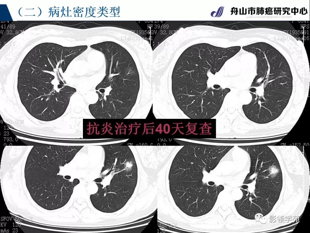 影像PPT - 【PPT】肺良恶性结节CT征象及鉴别诊断-33