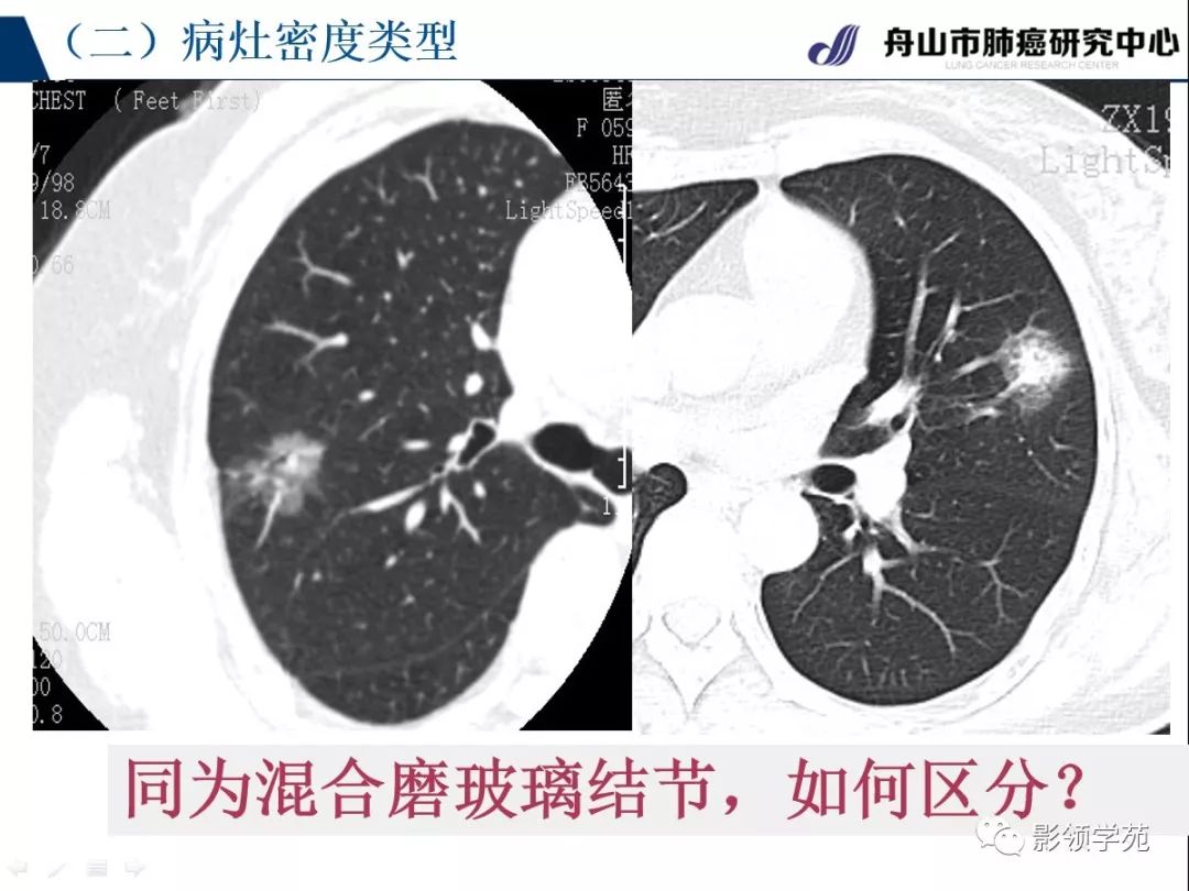 影像PPT - 【PPT】肺良恶性结节CT征象及鉴别诊断-34