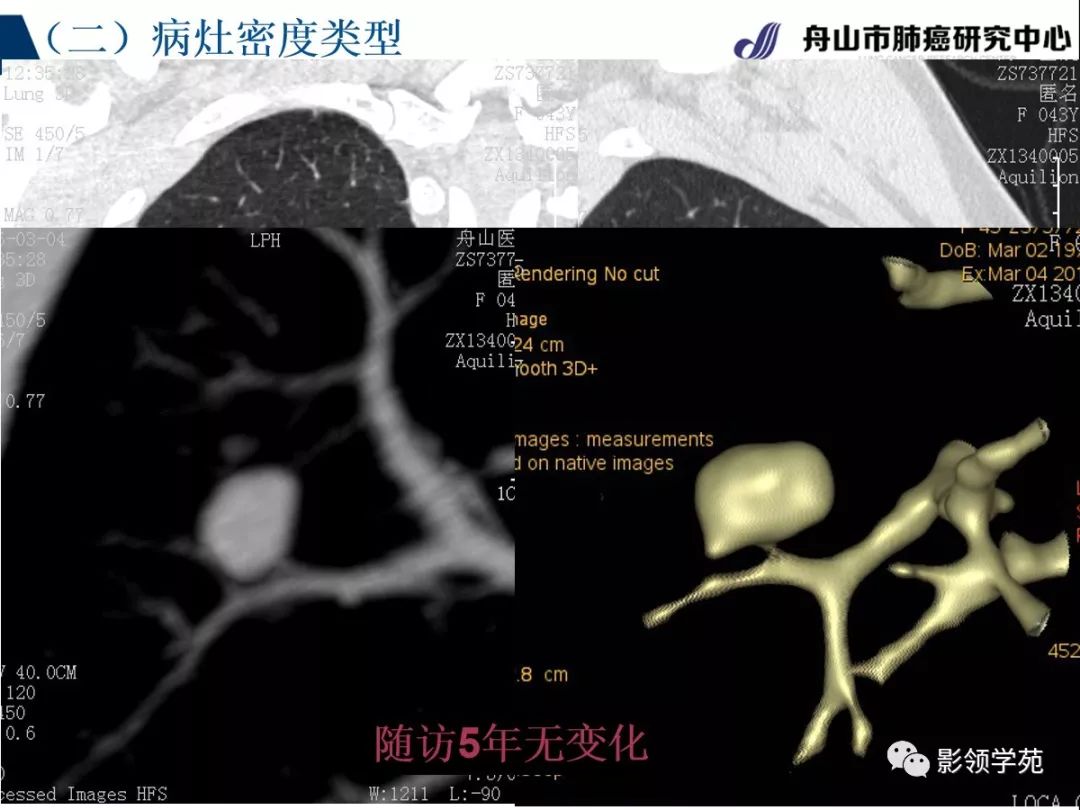 影像PPT - 【PPT】肺良恶性结节CT征象及鉴别诊断-37