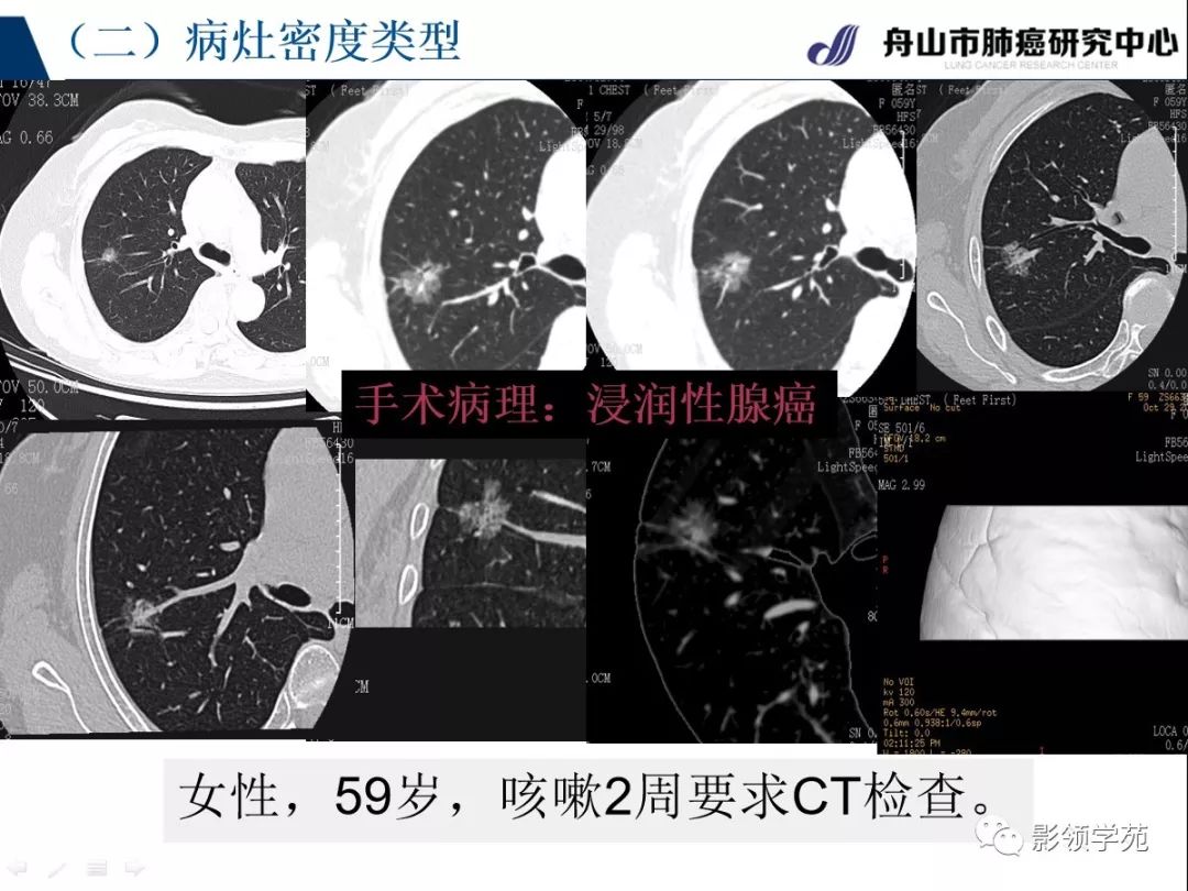 影像PPT - 【PPT】肺良恶性结节CT征象及鉴别诊断-32