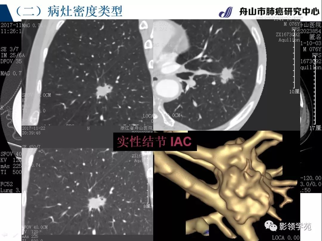 影像PPT - 【PPT】肺良恶性结节CT征象及鉴别诊断-35