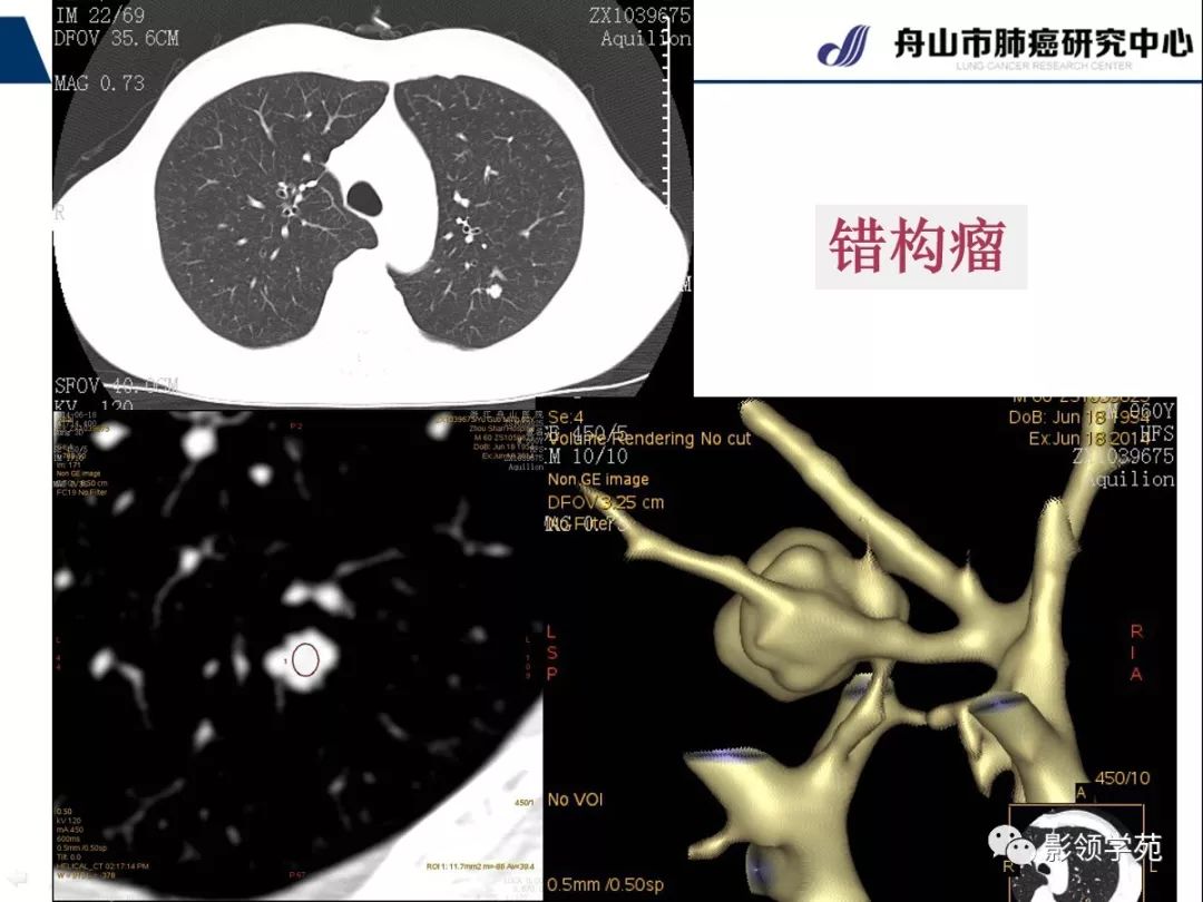 影像PPT - 【PPT】肺良恶性结节CT征象及鉴别诊断-39