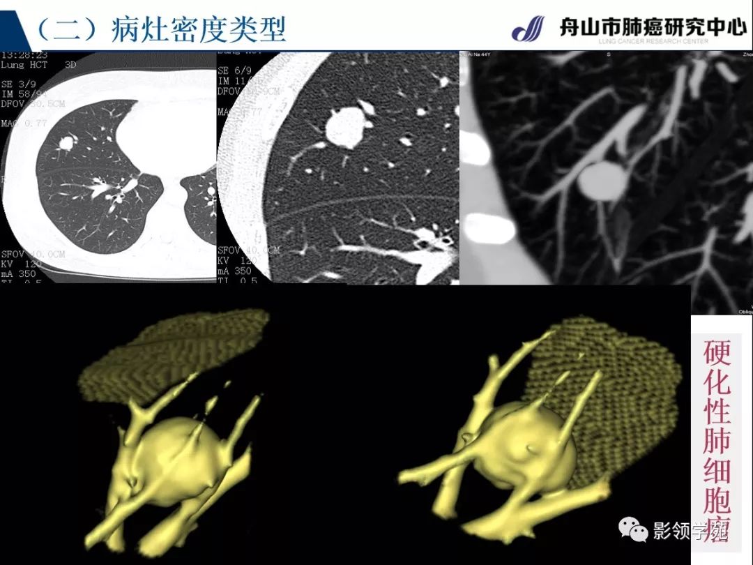 影像PPT - 【PPT】肺良恶性结节CT征象及鉴别诊断-40
