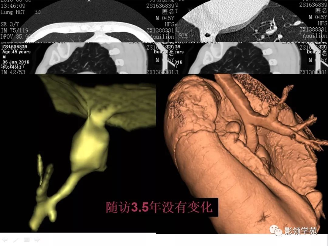 影像PPT - 【PPT】肺良恶性结节CT征象及鉴别诊断-38
