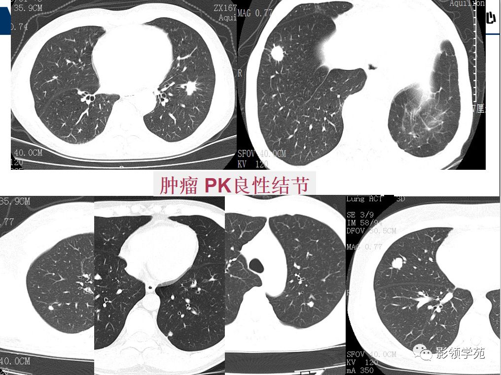 影像PPT - 【PPT】肺良恶性结节CT征象及鉴别诊断-41
