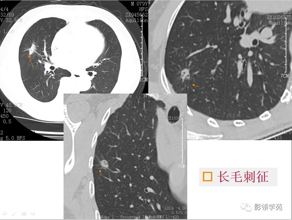 影像PPT - 【PPT】肺良恶性结节CT征象及鉴别诊断-45