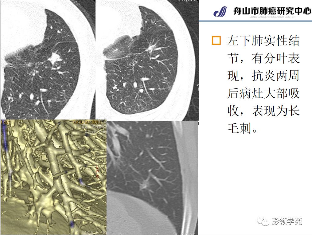 影像PPT - 【PPT】肺良恶性结节CT征象及鉴别诊断-46