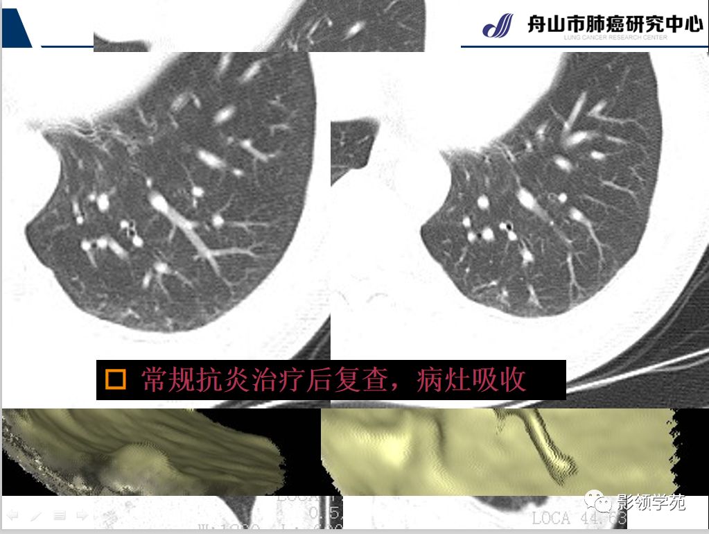 影像PPT - 【PPT】肺良恶性结节CT征象及鉴别诊断-49