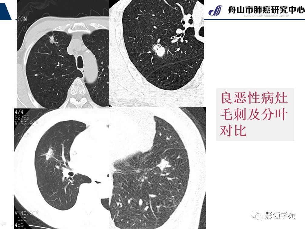 影像PPT - 【PPT】肺良恶性结节CT征象及鉴别诊断-47