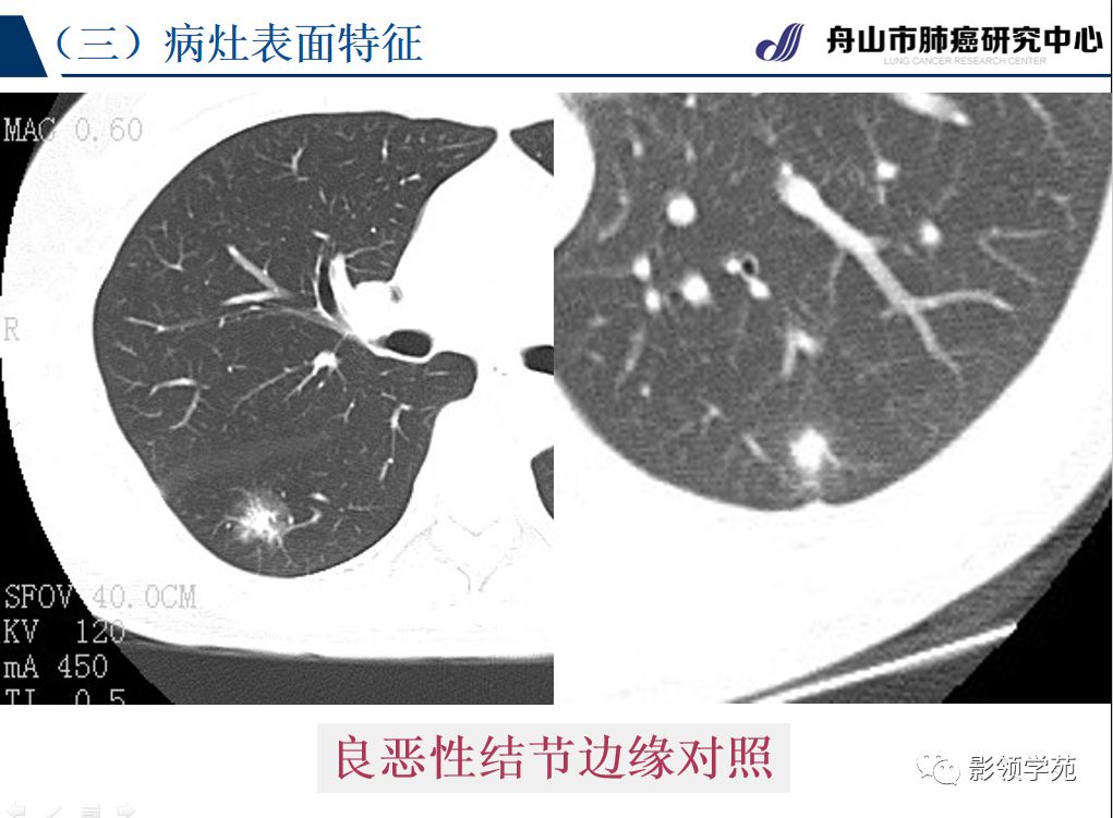 影像PPT - 【PPT】肺良恶性结节CT征象及鉴别诊断-50