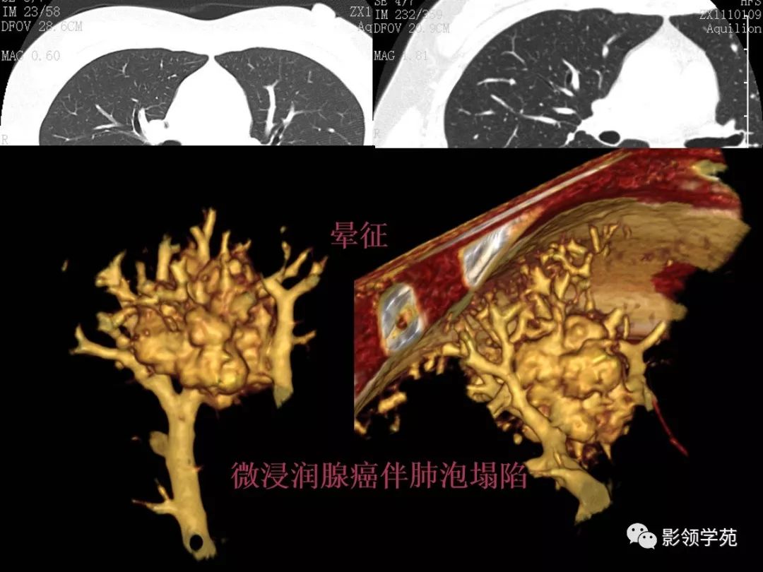 影像PPT - 【PPT】肺良恶性结节CT征象及鉴别诊断-48