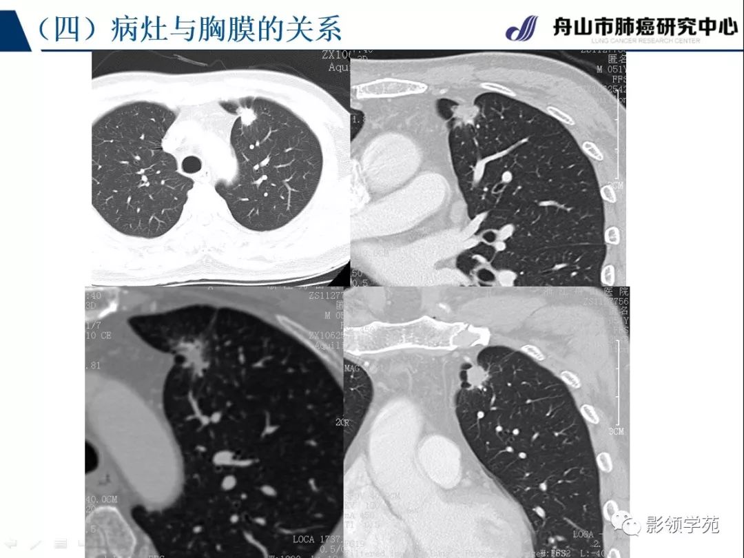 影像PPT - 【PPT】肺良恶性结节CT征象及鉴别诊断-52