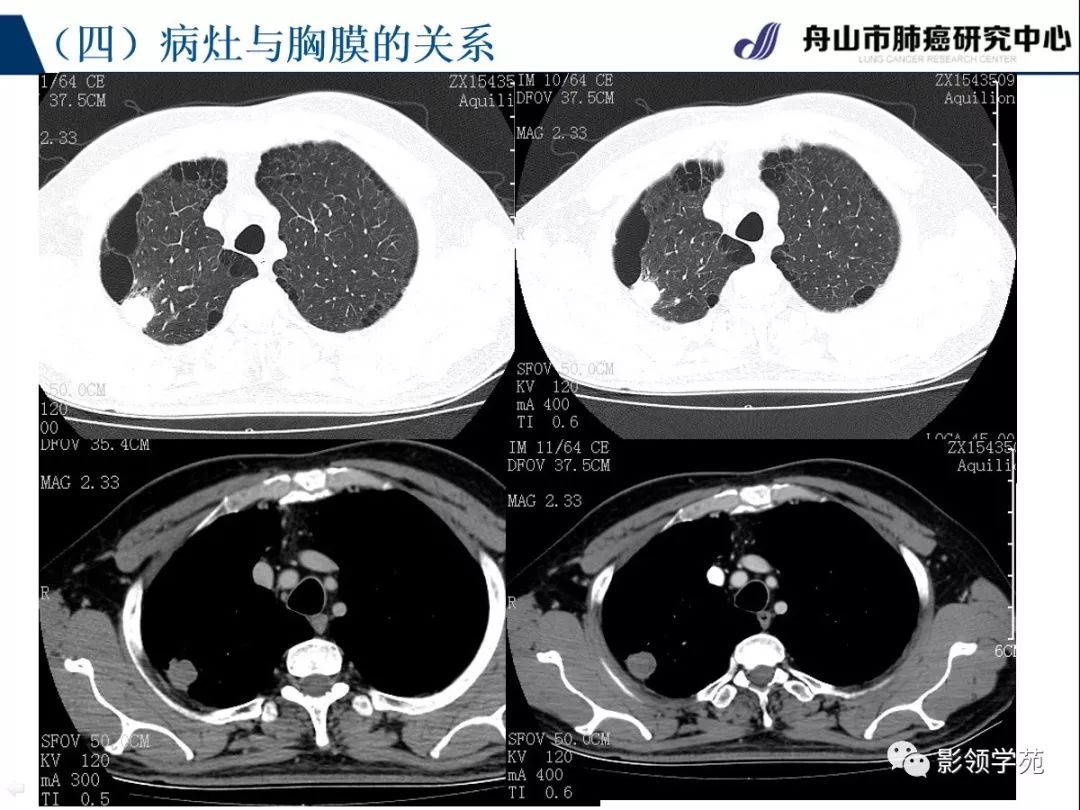 影像PPT - 【PPT】肺良恶性结节CT征象及鉴别诊断-54