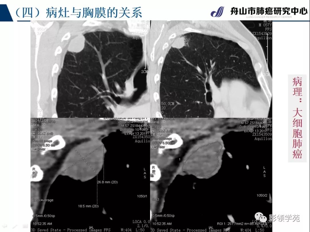影像PPT - 【PPT】肺良恶性结节CT征象及鉴别诊断-55