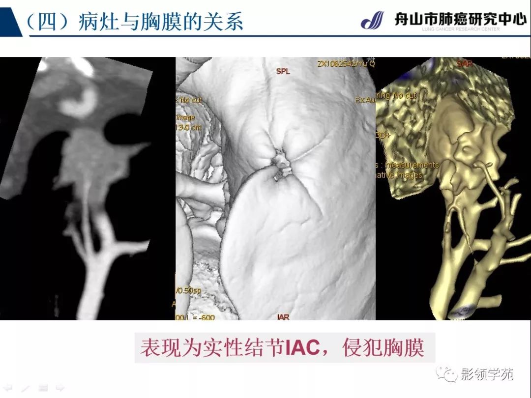 影像PPT - 【PPT】肺良恶性结节CT征象及鉴别诊断-53