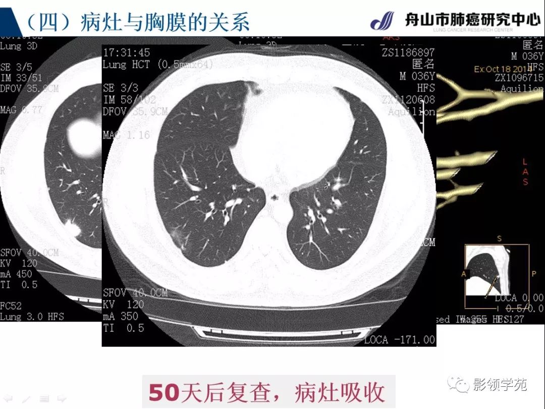 影像PPT - 【PPT】肺良恶性结节CT征象及鉴别诊断-56