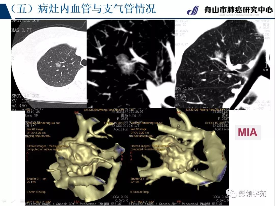 影像PPT - 【PPT】肺良恶性结节CT征象及鉴别诊断-59