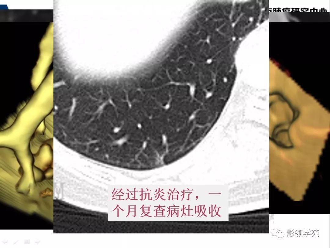 影像PPT - 【PPT】肺良恶性结节CT征象及鉴别诊断-57