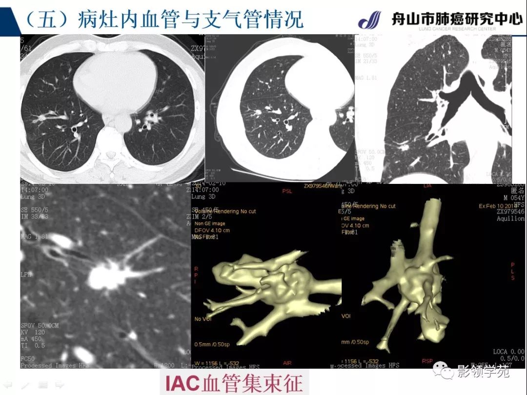 影像PPT - 【PPT】肺良恶性结节CT征象及鉴别诊断-60