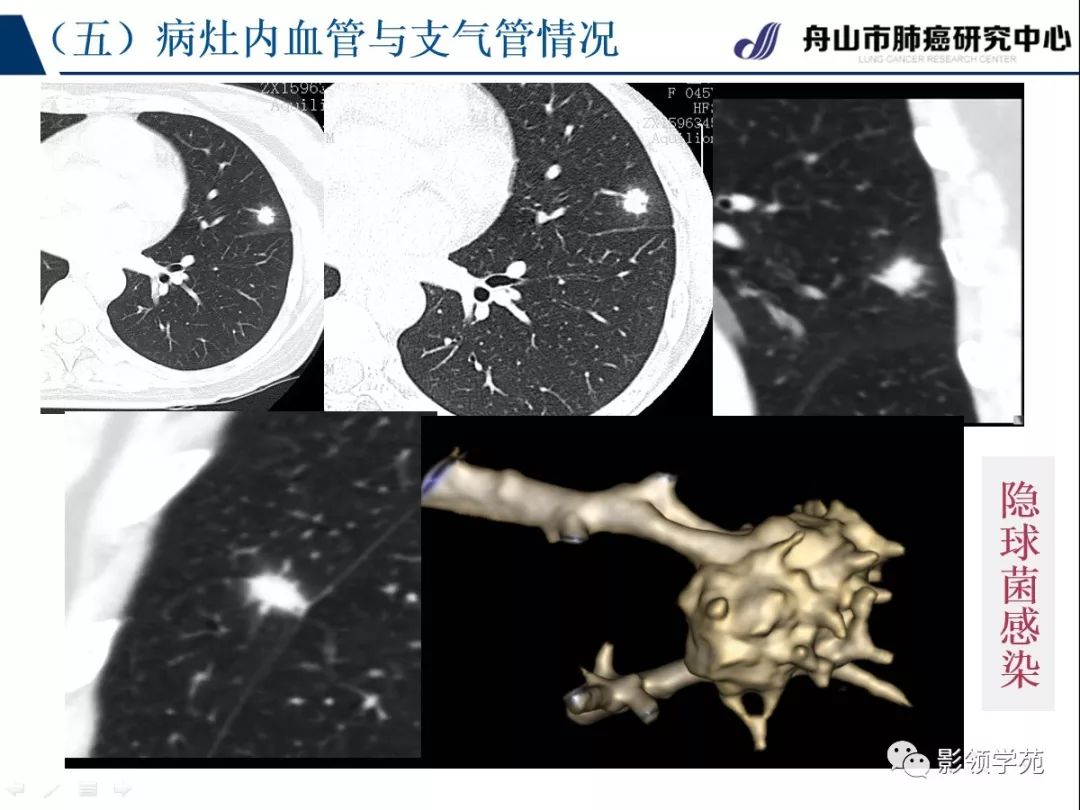 影像PPT - 【PPT】肺良恶性结节CT征象及鉴别诊断-62