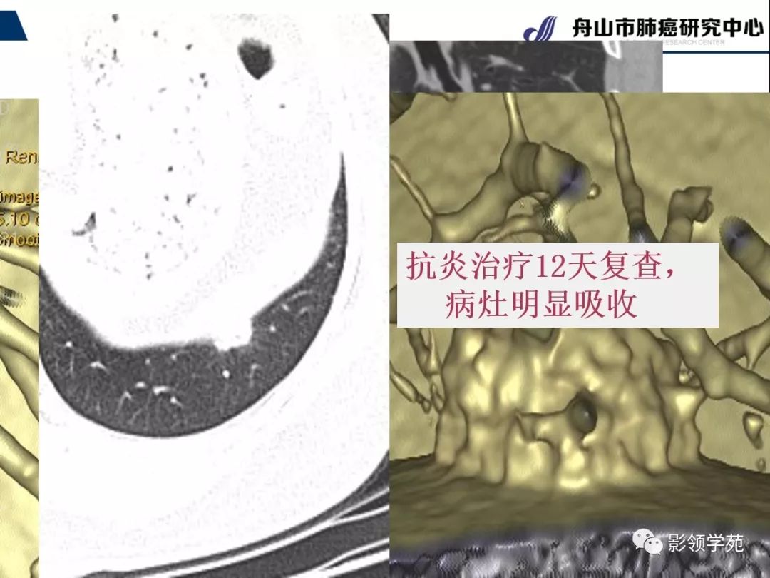 影像PPT - 【PPT】肺良恶性结节CT征象及鉴别诊断-63