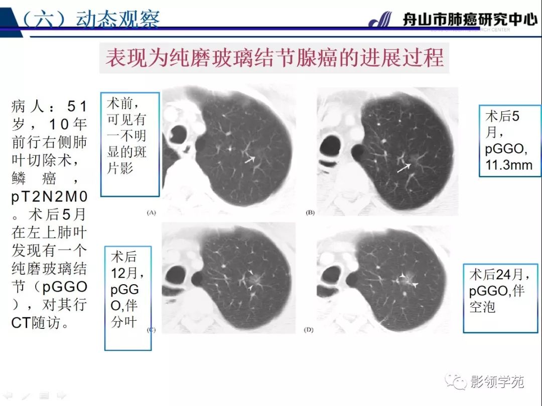 影像PPT - 【PPT】肺良恶性结节CT征象及鉴别诊断-64