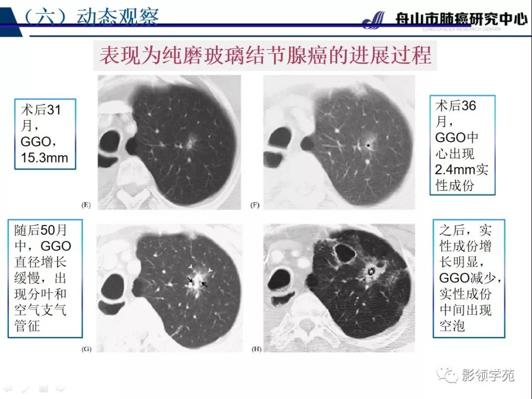 影像PPT - 【PPT】肺良恶性结节CT征象及鉴别诊断-65