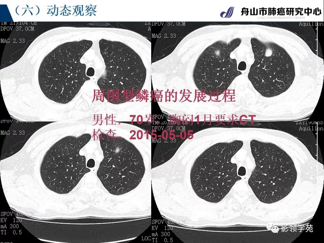 影像PPT - 【PPT】肺良恶性结节CT征象及鉴别诊断-66
