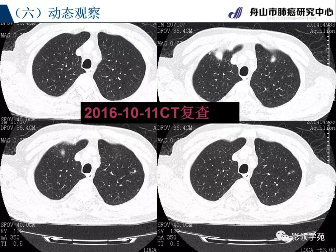 影像PPT - 【PPT】肺良恶性结节CT征象及鉴别诊断-67