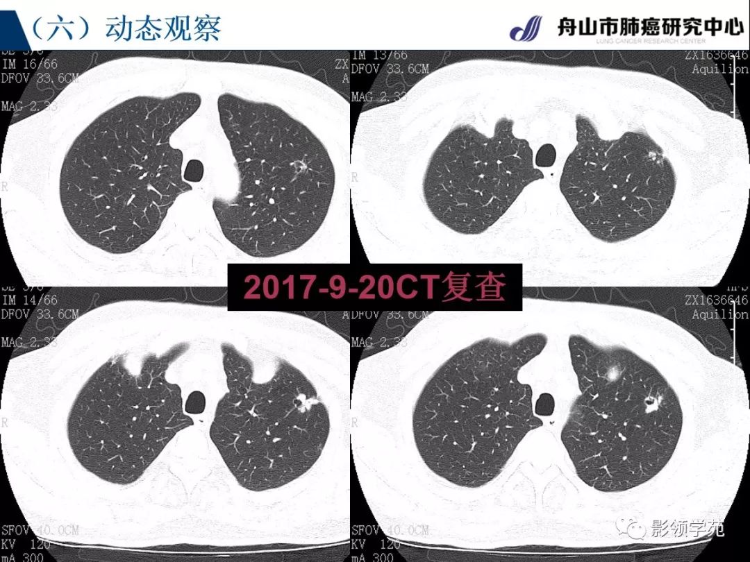 影像PPT - 【PPT】肺良恶性结节CT征象及鉴别诊断-68