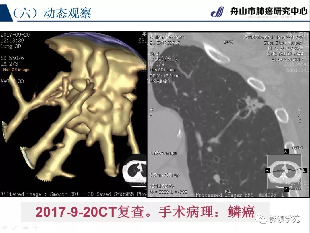 影像PPT - 【PPT】肺良恶性结节CT征象及鉴别诊断-69