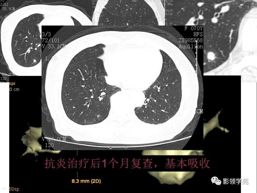 影像PPT - 【PPT】肺良恶性结节CT征象及鉴别诊断-70