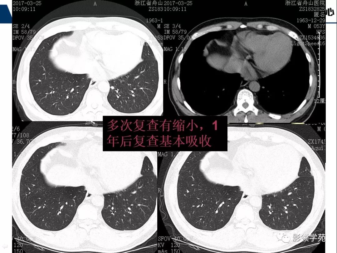 影像PPT - 【PPT】肺良恶性结节CT征象及鉴别诊断-71