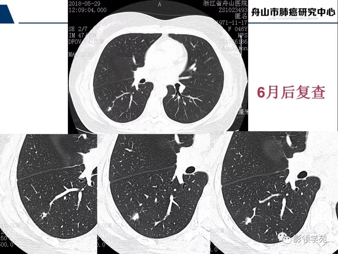 影像PPT - 【PPT】肺良恶性结节CT征象及鉴别诊断-77