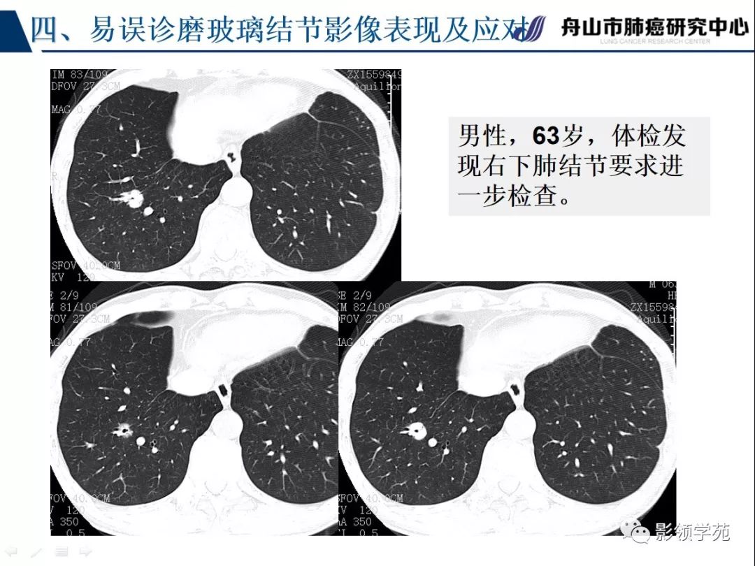 影像PPT - 【PPT】肺良恶性结节CT征象及鉴别诊断-81