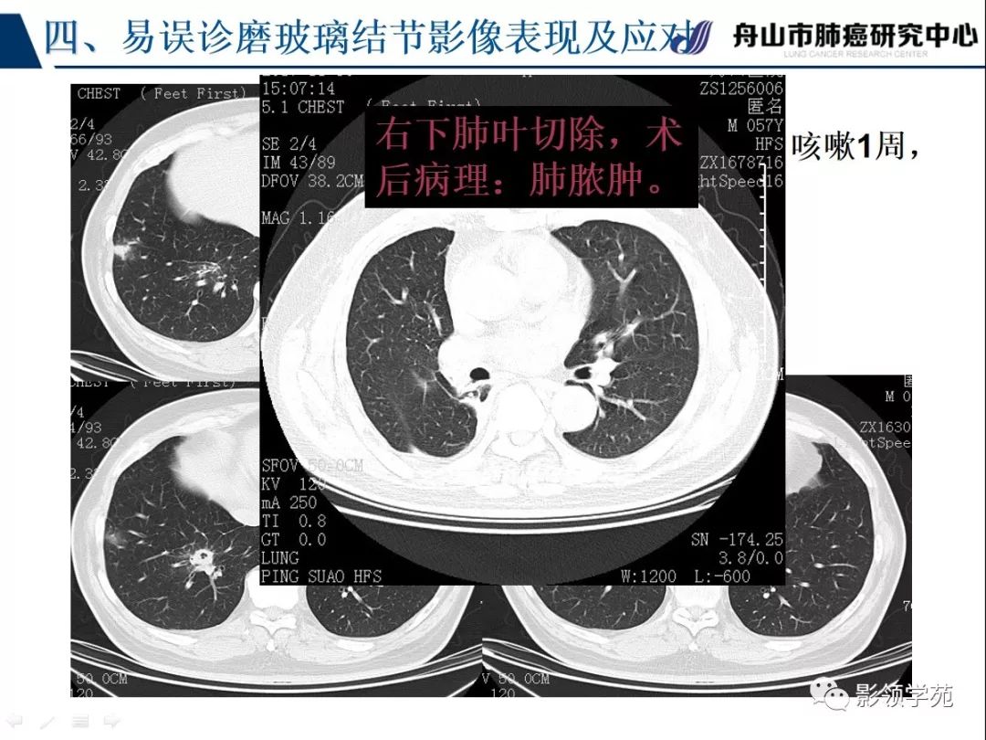 影像PPT - 【PPT】肺良恶性结节CT征象及鉴别诊断-78