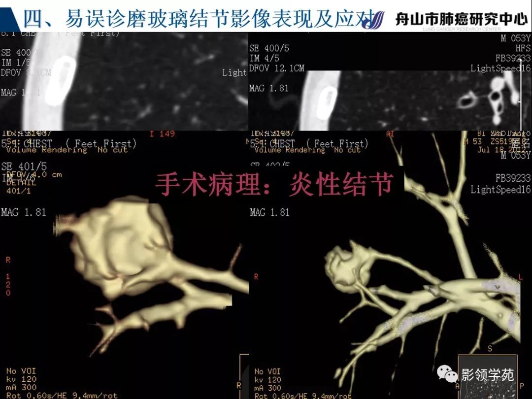 影像PPT - 【PPT】肺良恶性结节CT征象及鉴别诊断-80