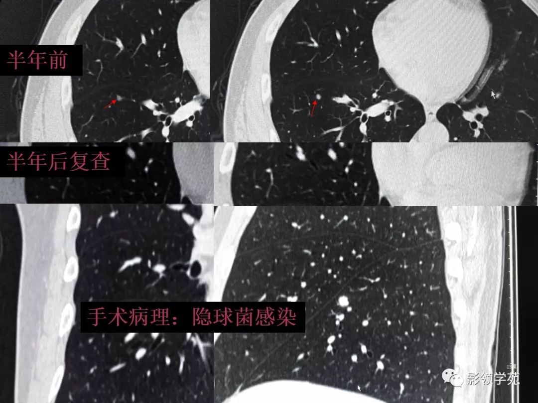 影像PPT - 【PPT】肺良恶性结节CT征象及鉴别诊断-79