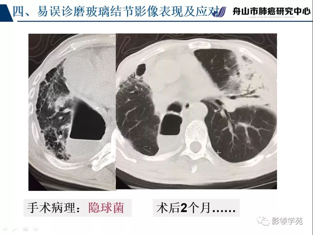 影像PPT - 【PPT】肺良恶性结节CT征象及鉴别诊断-83