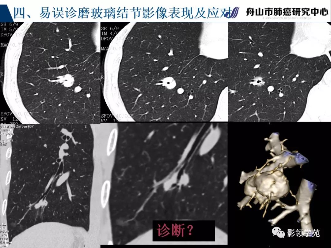 影像PPT - 【PPT】肺良恶性结节CT征象及鉴别诊断-82
