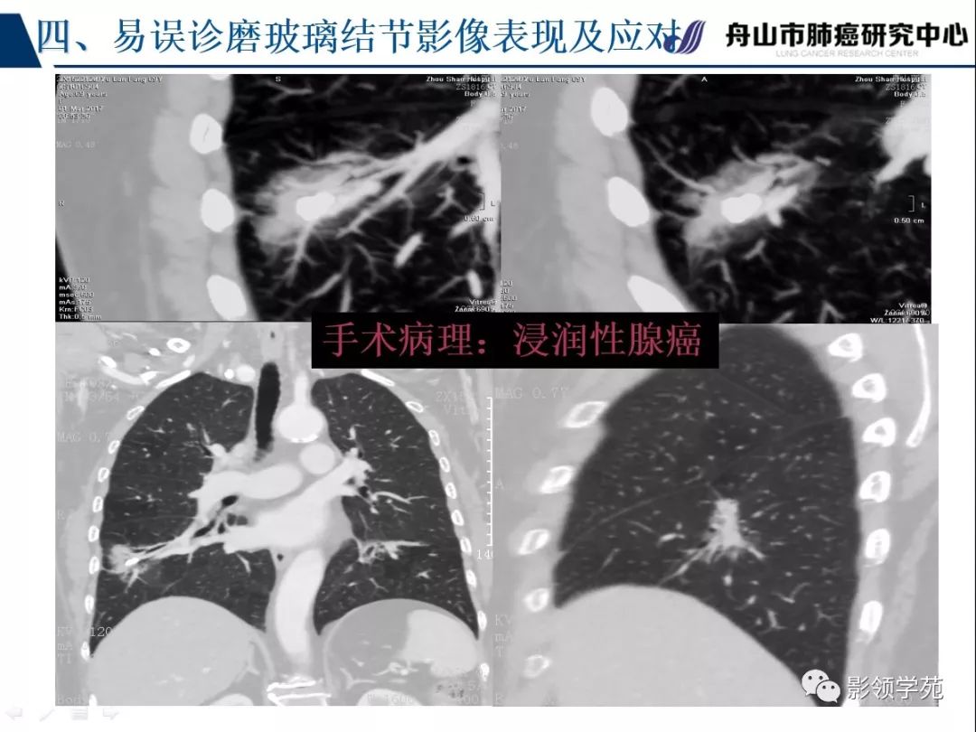 影像PPT - 【PPT】肺良恶性结节CT征象及鉴别诊断-86