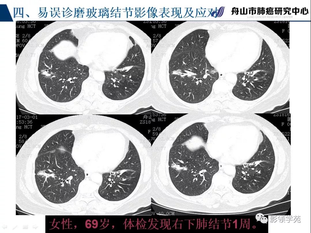 影像PPT - 【PPT】肺良恶性结节CT征象及鉴别诊断-84